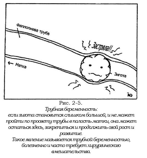 трубная беременность.JPG